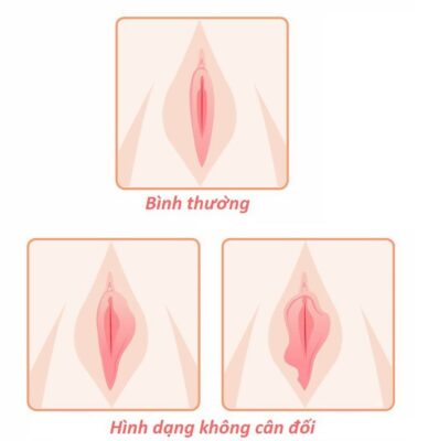 Cach Lam Hong Co Be Khong Can Phau Thuat